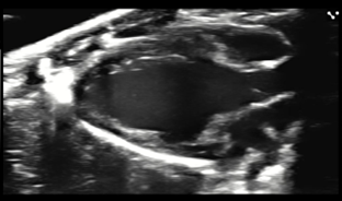 PSLA view left ventricle